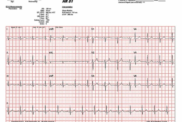 QT Prolongation Monitoring for COVID-19 Patients Now Available